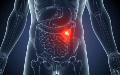 Tipos de Hernias: Guía Completa para Público General y Estudiantes